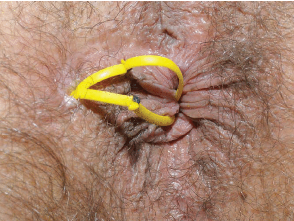 Imagen de sedal o setón colocado en fístula anal compleja para su tratamiento progresivo