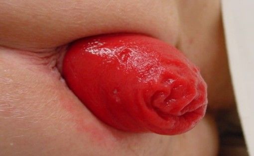 Foto de un prolapso rectal de pared completa