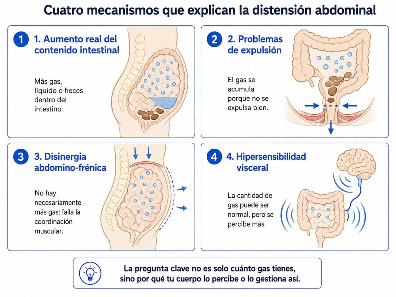Infografía de los cuatro mecanismos que explican la distensión abdominal