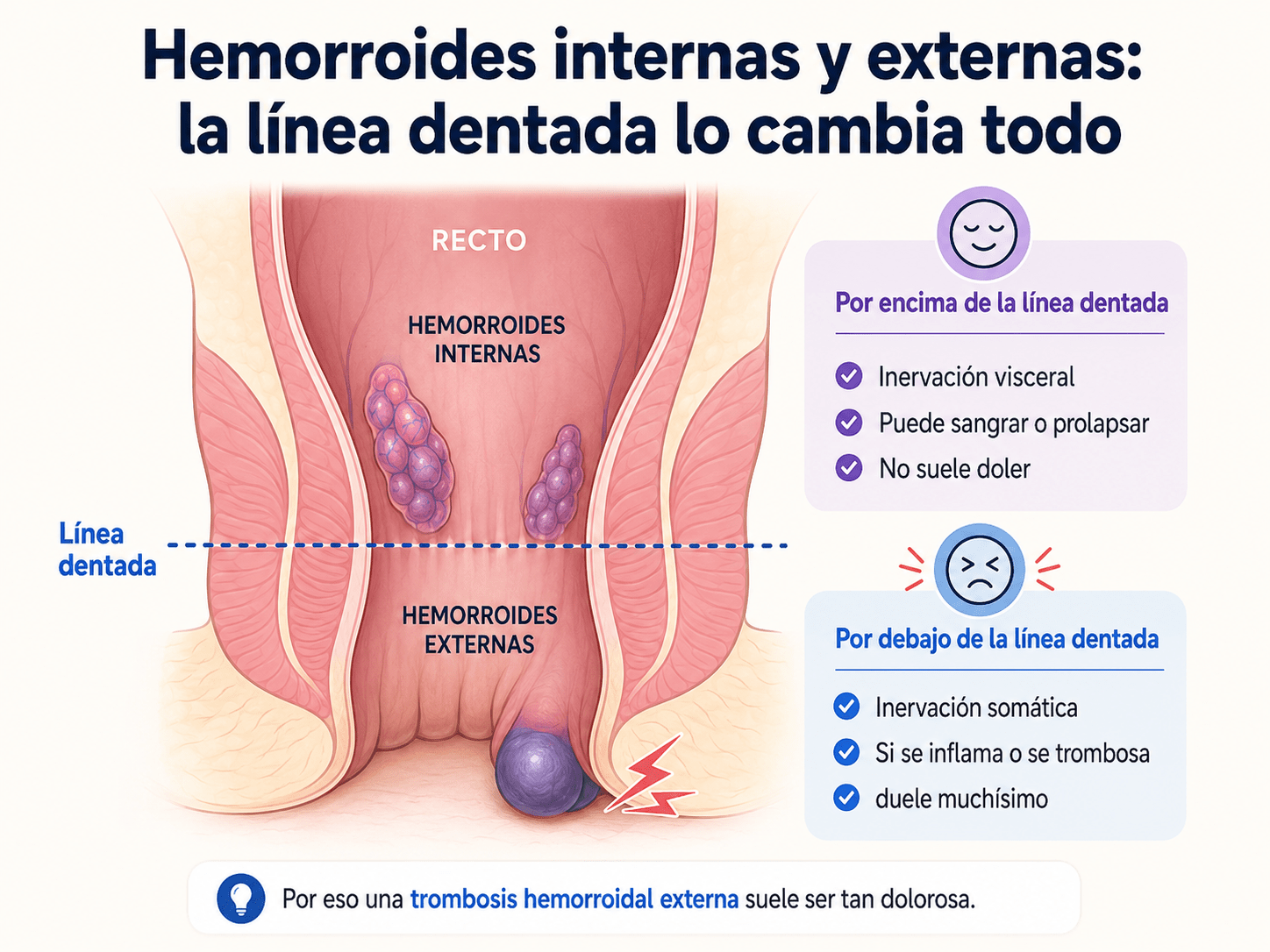 Esquema del canal anal mostrando la línea dentada y la diferencia entre hemorroides internas y externas