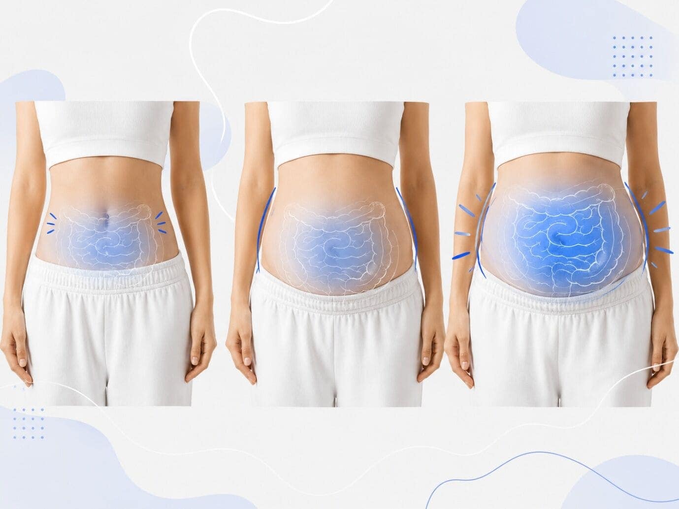 Tres fotografías comparativas de la progresión de la distensión abdominal a lo largo del día
