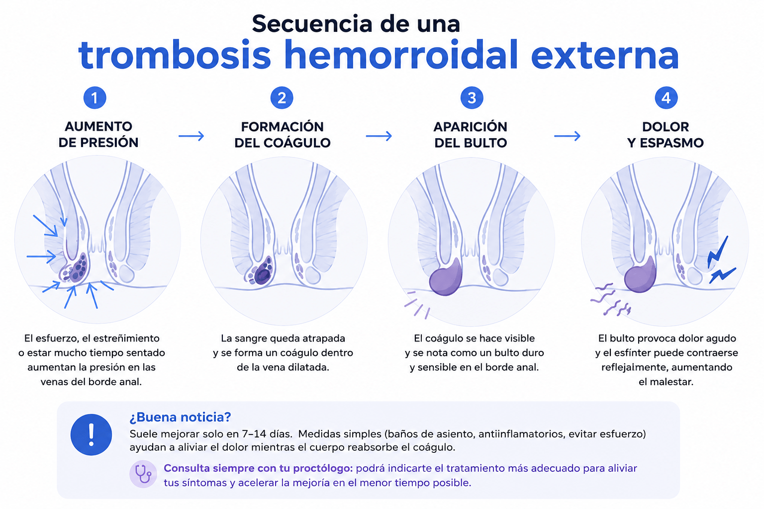 Cuatro fases de una trombosis hemorroidal externa: aumento de presión, formación del coágulo, aparición del bulto y dolor con espasmo